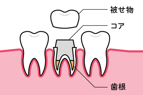 クラウンによる歯科補綴治療の図