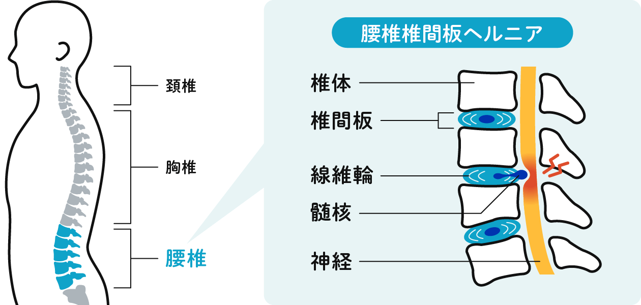 腰椎椎間板ヘルニアの図