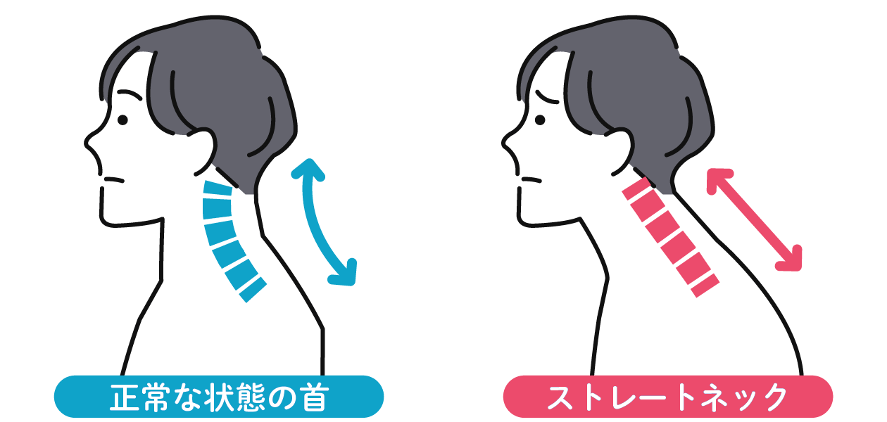ストレートネックと正常な状態の首の比較図